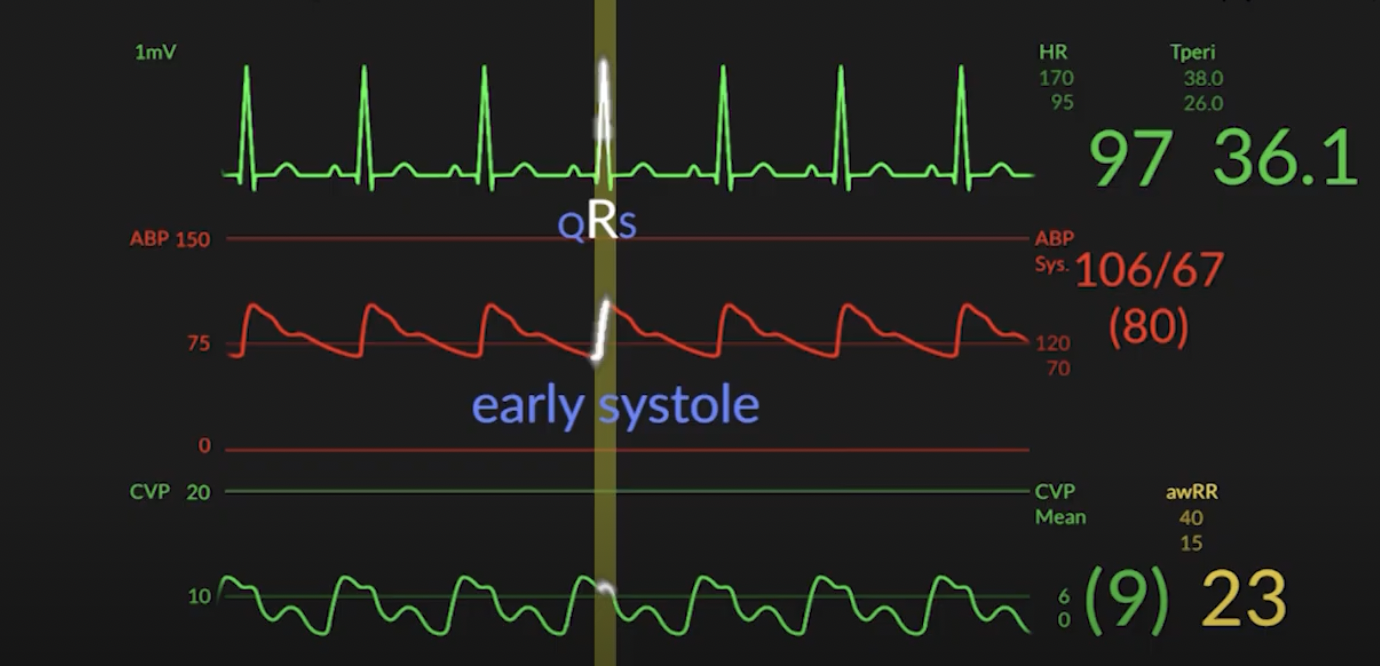 Under pressure, a CVP simplified tracing review – Code Team Pearls